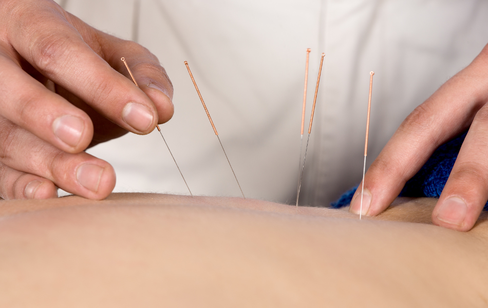 Benefits of Acupuncture for Addiction Recovery